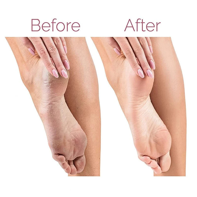 Dual Speed Electric Foot Callus Remover